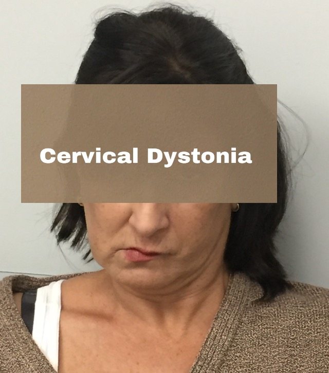 what is Cervical Dystonia?