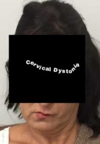 Cervical Dystonia