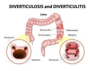 photos of diverticulosis and diverticulitis