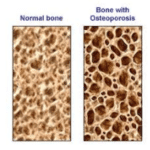 what is osteoporosis