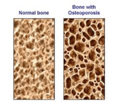 what is osteoporosis