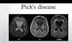 what is pick's disease