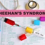 all about sheehans syndrome