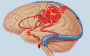 What Are Dural Arteriovenous Fistulas?