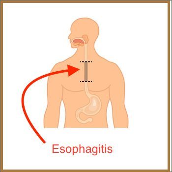 WHAT IS EOSINOPHILIC ESOPHAGITIS (EoE)?