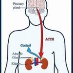 cushings syndrome symptoms