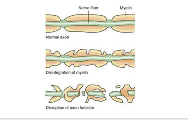 estrogen and cidp