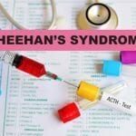 all about sheehans syndrome