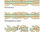 estrogen and cidp