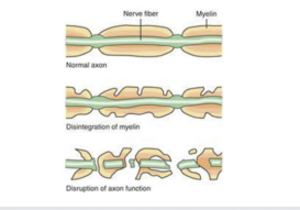 estrogen and cidp