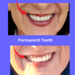 Dear Dr. Hada,

I am writing to express my deep concern and disappointment regarding the outcome of my recent dental treatment. Your latest message came across as self-serving and dismissive, and I feel compelled to respond with clarity and honesty.

As noted in my health chart, I have adrenal insufficiency, which makes any medical or dental procedure physically taxing. The added stress of having to endure multiple veneer removals and replacements has significantly impacted my health. Stress of any kind takes a serious toll on my body.
In addition to adrenal failure, I also live with:
* Hypopituitarism
* Chronic pulmonary embolisms
* Relapsing Polychondritis

You were informed of my medical conditions prior to treatment. 

When I explained my experience with you placed my veneers incorrectly implanted not once, but twice, the referring ortdontist was visibly surprised and concerned. He expressed confusion about why you continued placing the veneers after the first sign of an error. He likened the oversight to painting a wall the wrong color and not noticing it immediately. His dental assistants also questioned why proper color checks weren’t done first. 

The use of Nitrous Oxide in my case, despite my complex health conditions, has further compromised my immune system. I’ve had to increase steroid medications, visit multiple specialists, and pay for costly compounded medications—none of which would have been necessary had proper precautions been taken.

Your office initially offered to refund my payment without conditions. I have not asked for compensation for my medical issues—only the promised refund. Now you’re imposing new conditions that feel arbitrary and controlling. I do not accept being supervised or restricted in how the refund is returned.

Neighbors and friends are shocked by my experience. The fact that six veneers were placed and then immediately chiseled out is difficult to comprehend. I was devastated by the final result, especially after the rushed nature of my second appointment. You spent less than an hour placing the veneers and then insisted they looked “fabulous.” I was near tears looking in the mirror—one tooth was clearly bucked, and I immediately voiced my concern. You minimized my feedback, shaved down one tooth, and told me the appearance would improve once swelling went down. You also dismissed my concern by saying, “I’m sure you have things to do.”

The next day, when I picked up my retainer (January 25, 2024), you acknowledged that my permanent veneers looked different from the temporaries. Still, no corrective action was taken.
The idea of returning to your office for another appointment is distressing. Whether molds were lost or mishandled is not my responsibility. I’ve sent you photos showing misalignment in my front teeth.
I trusted your care based on my orthodontist’s referral . Your fee was nearly double that of my original dentist, but I believed it reflected expertise. Unfortunately, that trust was misplaced.
At this point, I am still paying Care Credit for a service I did not receive. That feels unethical and, frankly, like theft.
Please confirm today whether you will honor your original promise and refund me directly—without new stipulations. I deserve closure and fairness.

There was no reply to this email. 

You can watch a TikTok video https://www.tiktok.com/@hypogal/video/7491819849988033822
of Dr. Hada placing the wrong veneers in mouth. Why did Dr. Hada fail to check the veneer color before he broke my teeth?

What would you do in this dental situation? 
