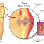 symptoms of gout