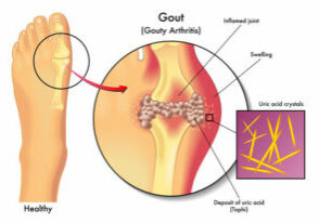 symptoms of gout